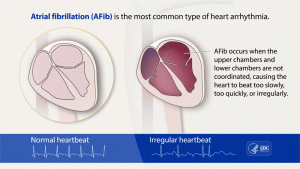 Alivecor Kardiamobile Atrial Fibrillation